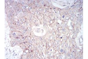 Immunohistochemistry (IHC) image for anti-Zinc Finger Protein GLI1 (GLI1) (AA 284-449) antibody (ABIN5866847) (GLI1 antibody  (AA 284-449))