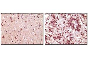 Immunohistochemical analysis of paraffin-embedded human brain tumor tissue, showing nuclear and cytoplasmic localization using ELK1 mouse mAb with DAB staining. (ELK1 antibody)