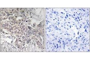 Immunohistochemistry analysis of paraffin-embedded human liver carcinoma tissue, using Cytochrome P450 4Z1 Antibody. (CYP4Z1 antibody  (AA 71-120))