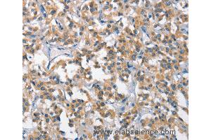 Immunohistochemistry of Human gastric cancer using SCARB1 Polyclonal Antibody at dilution of 1:65