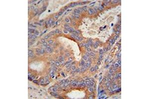 Immunohistochemistry analysis in formalin fixed and paraffin embedded human prostate carcinoma reacted with GLB1L2 Antibody (C-term) followed by peroxidase conjugation of the secondary antibody and DAB staining. (GLB1L2 antibody  (C-Term))