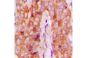 Immunohistochemical analysis of MMP13 staining in human breast cancer formalin fixed paraffin embedded tissue section. (MMP13 antibody  (N-Term))