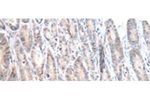 Immunohistochemistry of paraffin-embedded Human gastric cancer tissue using CALB2 Polyclonal Antibody at dilution of 1:25(x200) (Calretinin antibody)