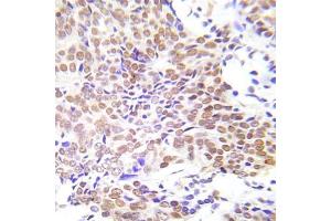 Immunohistochemical analysis of paraffin- embedded human lung adenocarcinoma tissue using HDAC1 (Ab-421/423) Antibody (E022085). (HDAC1 antibody)