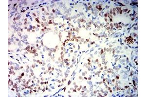 Immunohistochemical analysis of paraffin-embedded cervical cancer tissues using PGR mouse mAb with DAB staining.