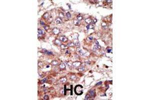 Formalin-fixed and paraffin-embedded human hepatocellular carcinoma tissue reacted with the ACSL6 polyclonal antibody  , which was peroxidase-conjugated to the secondary antibody, followed by AEC staining. (ACSL6 antibody  (Internal Region))
