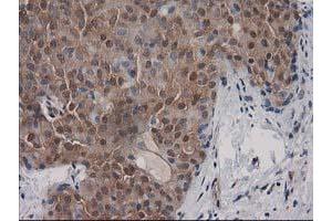 Immunohistochemical staining of paraffin-embedded Adenocarcinoma of Human breast tissue using anti-DSTN mouse monoclonal antibody.