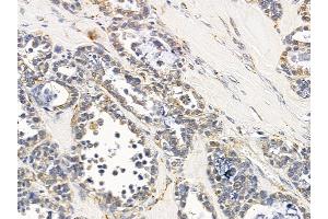 ABIN6258026 and ABIN6275228 at 1/100 staining human ovarian cancer by IHC-P.