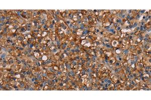 Immunohistochemistry of paraffin-embedded Human prostate cancer tissue using NEDD4L Polyclonal Antibody at dilution 1:60 (NEDD4-2 antibody)