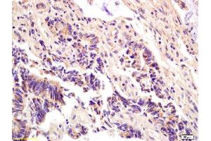 Formalin-fixed and paraffin embedded human colon carcinoma labeled with Anti-ompF(putative outer membrane porin F protein) Polyclonal Antibody, Unconjugated  at 1:200 followed by conjugation to the secondary antibody and DAB staining. (Ompf (AA 171-213) antibody)