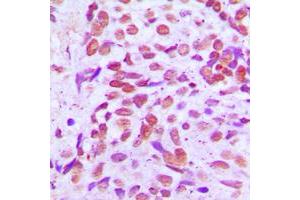 Immunohistochemical analysis of SENP8 staining in human breast cancer formalin fixed paraffin embedded tissue section.