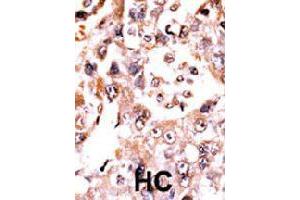 Formalin-fixed and paraffin-embedded human hepatocellular carcinoma tissue reacted with DUSP3 polyclonal antibody  , which was peroxidase-conjugated to the secondary antibody, followed by AEC staining.