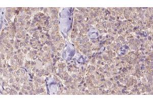 ABIN6273342 at 1/100 staining Human thyroid cancer tissue by IHC-P. (USP9X antibody  (N-Term))