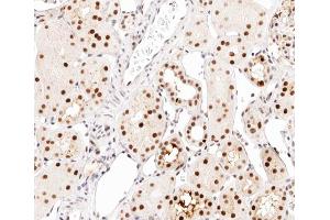 ABIN6267542 at 1/200 staining human kidney carcinoma tissue sections by IHC-P. (CEBPA antibody  (pSer21))