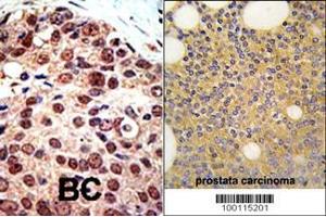 Formalin-fixed and paraffin-embedded human prostata carcinoma tissue reacted with PRMT3 Antibody (C-term) (ABIN387839 and ABIN2843941) , which was peroxidase-conjugated to the secondary antibody, followed by DAB staining. (PRMT3 antibody  (C-Term))