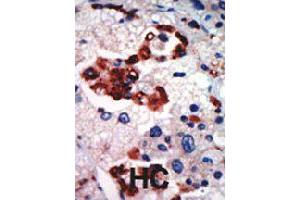 Formalin-fixed and paraffin-embedded human hepatocellular carcinoma tissue reacted with PRKCI polyclonal antibody  , which was peroxidase-conjugated to the secondary antibody, followed by AEC staining . (PKC iota antibody  (N-Term))