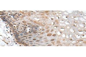 Immunohistochemistry of paraffin-embedded Human esophagus cancer tissue using CHRNA5 Polyclonal Antibody at dilution of 1:50(x200) (CHRNA5 antibody)