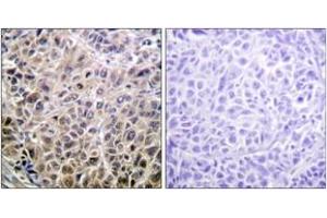 Immunohistochemistry analysis of paraffin-embedded human liver carcinoma tissue, using DAPK1 (Ab-308) Antibody.