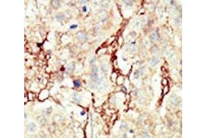 IHC analysis of FFPE human breast carcinoma tissue stained with the FGFR3 antibody