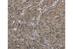 Immunohistochemistry of Human gastric cancer using CLPS Polyclonal Antibody at dilution of 1:40