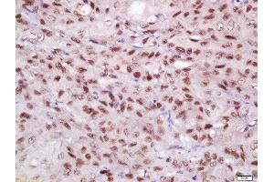 Formalin-fixed and paraffin embedded human laryngeal carcinoma tissue labeled with Rabbit Anti-EIF3S4 Polyclonal Antibody, Unconjugated  at 1:200 followed by conjugation to the secondary antibody and DAB staining (EIF3G antibody  (AA 51-150))