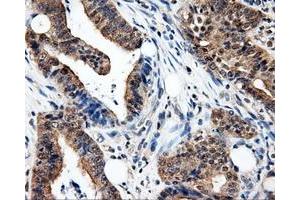 Immunohistochemical staining of paraffin-embedded Adenocarcinoma of colon tissue using anti-PSMC3 mouse monoclonal antibody. (PSMC3 antibody)