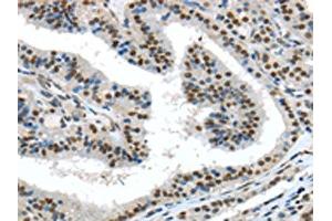 The image on the left is immunohistochemistry of paraffin-embedded Human thyroid cancer tissue using ABIN7131359(TKT Antibody) at dilution 1/30, on the right is treated with fusion protein. (TKT antibody)