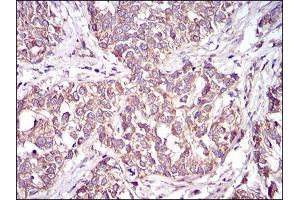 Immunohistochemical analysis of paraffin-embedded bladder cancer tissues using CD36 mouse mAb with DAB staining.