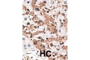 Formalin-fixed and paraffin-embedded human hepatocellular carcinoma tissue reacted with KCNIP3 polyclonal antibody  , which was peroxidase-conjugated to the secondary antibody, followed by AEC staining. (DREAM antibody  (N-Term))