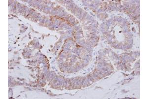 IHC-P Image Immunohistochemical analysis of paraffin-embedded human colon carcinoma, using LYN, antibody at 1:250 dilution. (LYN antibody  (Center))
