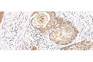 Immunohistochemistry of paraffin-embedded Human esophagus cancer tissue using EWSR1 Polyclonal Antibody at dilution of 1:70(x200) (EWSR1 antibody)