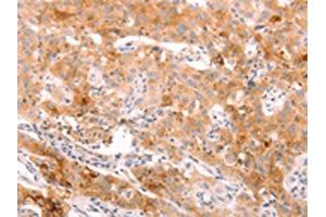 The image on the left is immunohistochemistry of paraffin-embedded Human lung cancer tissue using ABIN7189783(ALPPL2 Antibody) at dilution 1/20, on the right is treated with synthetic peptide. (ALPPL2 antibody)