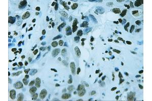 Immunohistochemical staining of paraffin-embedded Carcinoma of liver using anti-FOXA2 (ABIN2452672) mouse monoclonal antibody. (FOXA2 antibody  (AA 300-458))