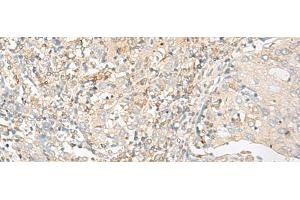 Immunohistochemistry of paraffin-embedded Human cervical cancer tissue using GLIS1 Polyclonal Antibody at dilution of 1:50(x200) (GLIS1 antibody)
