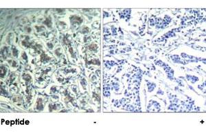 Immunohistochemical analysis of paraffin-embedded human breast carcinoma tissue using PLCG1 polyclonal antibody . (Phospholipase C gamma 1 antibody  (Tyr771))