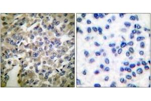 Immunohistochemistry analysis of paraffin-embedded human breast carcinoma tissue, using Synaptotagmin (Ab-309) Antibody. (Synaptotagmin antibody  (AA 276-325))