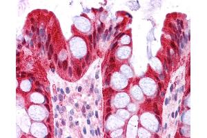 FABP1 antibody was used for immunohistochemistry at a concentration of 4-8 ug/ml. (FABP1 antibody  (N-Term))