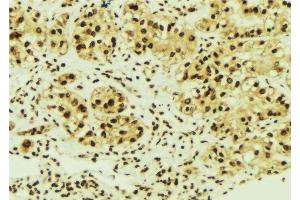 ABIN6276334 at 1/100 staining Human breast cancer tissue by IHC-P. (NME1 antibody  (C-Term))