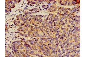 Immunohistochemistry of paraffin-embedded human ovarian cancer using ABIN7144300 at dilution of 1:100 (ANO1 antibody  (AA 1-151))