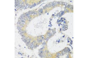 Immunohistochemistry of paraffin-embedded human colon carcinoma using Snail antibody (ABIN6132675, ABIN6148177, ABIN6148180 and ABIN6221190) at dilution of 1:100 (40x lens). (SNAIL antibody  (C-Term))