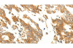 Immunohistochemistry of paraffin-embedded Human gastric cancer using RARRES1 Polyclonal Antibody at dilution of 1:60 (RARRES1 antibody)