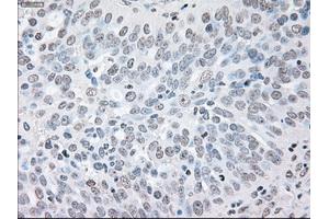 Immunohistochemical staining of paraffin-embedded Adenocarcinoma of colon tissue using anti-BRAFmouse monoclonal antibody. (BRAF antibody)