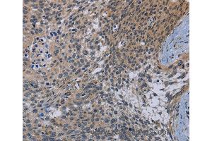 Immunohistochemistry of Human cervical cancer using CDC16 Polyclonal Antibody at dilution of 1:50 (CDC16 antibody)