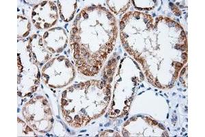 Immunohistochemical staining of paraffin-embedded Carcinoma of prostate tissue using anti-APP mouse monoclonal antibody. (APP antibody)