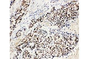 IHC-P: MCM3 antibody testing of human lung cancer tissue