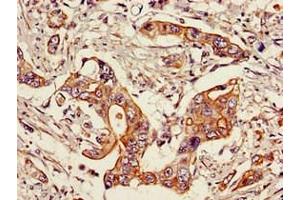 Immunohistochemistry of paraffin-embedded human pancreatic cancer using ABIN7169690 at dilution of 1:100 (STAT6 antibody  (AA 1-319))
