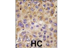 Formalin-fixed and paraffin-embedded human hepatocarcinoma tissue reacted with PFKFB1 antibody (Center), which was peroxidase-conjugated to the secondary antibody, followed by DAB staining. (PFKFB1 antibody  (AA 259-289))