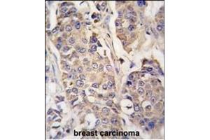 Formalin-fixed and paraffin-embedded human breast carcinoma tissue reacted with ACO2 antibody (Center) (ABIN391809 and ABIN2841660) , which was peroxidase-conjugated to the secondary antibody, followed by DAB staining. (ACO2 antibody  (AA 294-325))