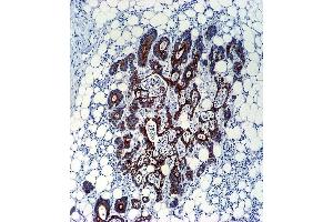 TGFB2 Antibody (ABIN659106 and ABIN2838086) immunohistochemistry analysis in formalin fixed and paraffin embedded human colon carcinoma followed by peroxidase conjμgation of the secondary antibody and DAB staining. (TGFB2 antibody)