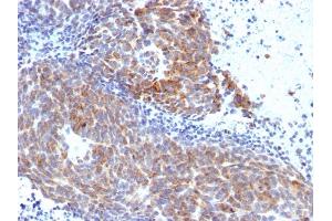 Formalin-fixed, paraffin-embedded human Melanoma stained with Topo I, MT Mouse Monoclonal Antibody (TOP1MT/568). (TOP1MT antibody)